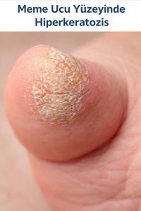 Mastitis Nedir? Erken Belirtiler, Subklinik Mastitis ve Sağım Hijyeni ile Korunma 3 hiperkeratozis örneği